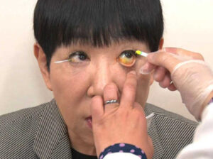 和田アキ子　眼瞼下垂　再手術　修正　ビフォーアフター